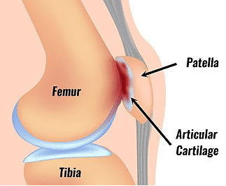 Zobrazení místa bolesti při běžeckém kolenu, které je nejčastějším zraněním běžců.