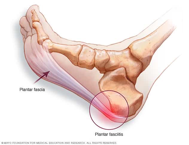 Point of heel pain from running in plantar fasciitis and heel spurs.