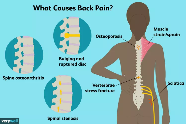 Různé příčiny bolesti zad u sportovců.