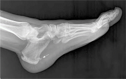 X-ray view of the heel spur. 