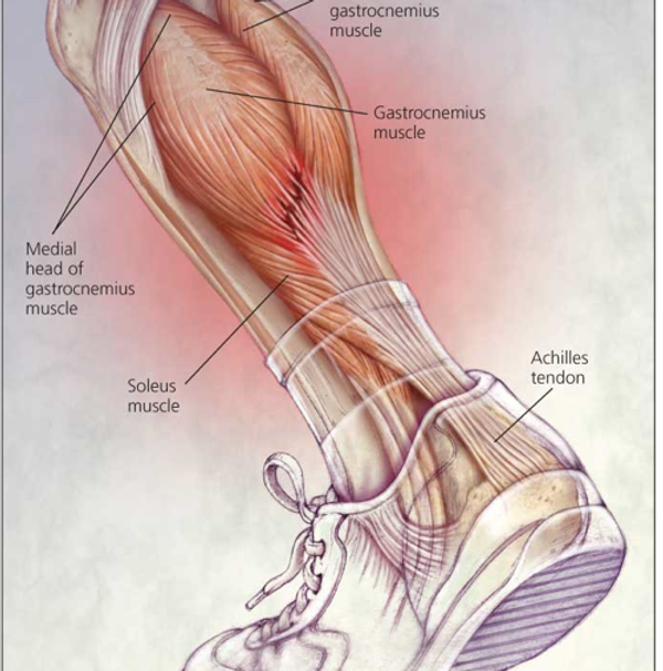 Vyobrazení poranění lýtkových svalů. 