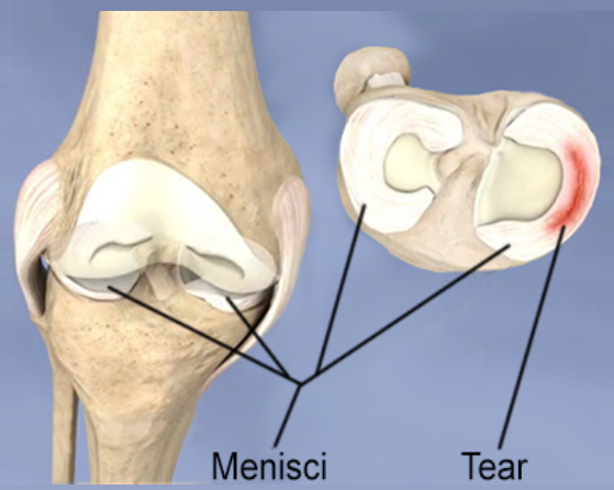 3D model ruptury menisku v kolenu.