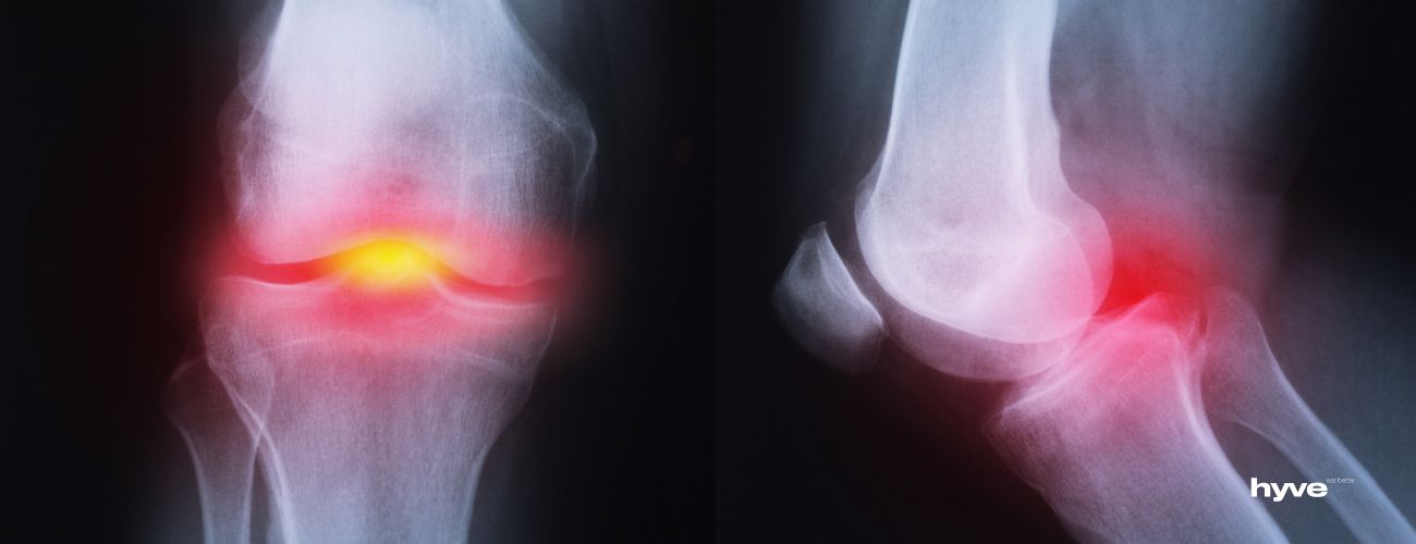 Začínající artróza kolene - místo bolesti.